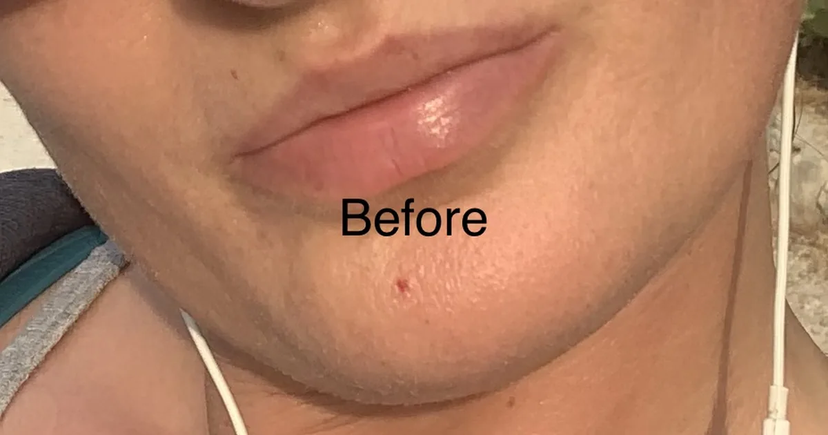 Botox La Paz CEDI